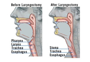 laryngecSC