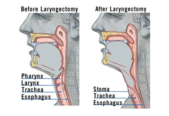 Laryngectomy